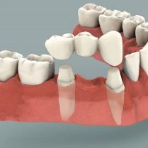 Dental-Bridge-300x209