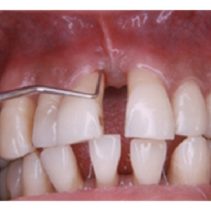 cure-agressive-periodontitis