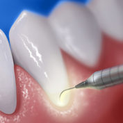 laser_periodontal_therapy